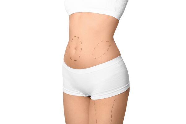 Tummy Tuck in Tijuana, Mexico - Plastic Surgery Procedure at Mexico Cosmetic Center in Hospital Azar